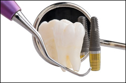 Dental Implants Kalamazoo, MI and Portage, MI
