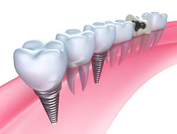 Dental Implants Portage, MI and Kalamazoo, MI